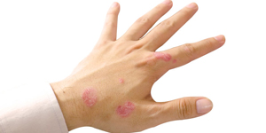 Psoriasis on white isolated